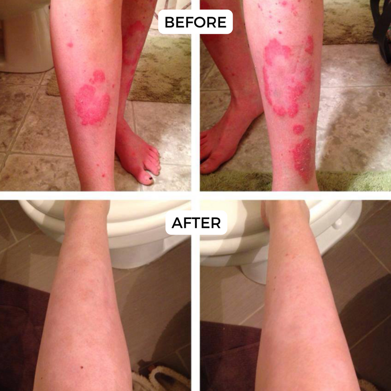 Before and After comparison of the treatment of skin on the lower legs