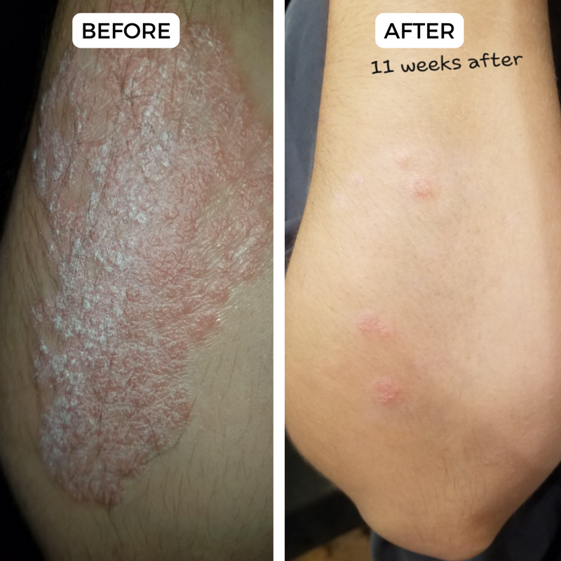Before and After comparison of a skin condition treatment