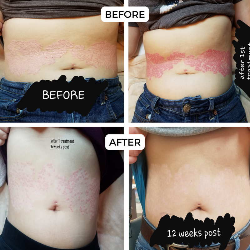 before-and-after comparisons of a treatment process on the skin
